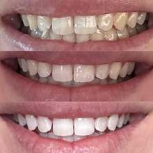 Before and after teeth whitening progression